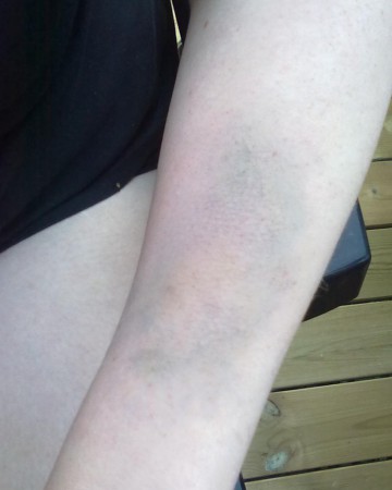 avtvättbart blåmärke